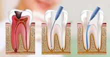 Endodoncia o tratamiento de canales