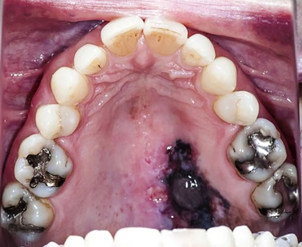 Lesión sospechosa de cáncer bucal detectada en evaluación dental en Vega Alta PR