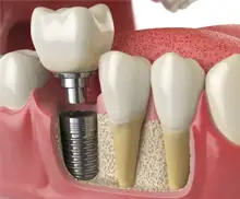 Implante dental único reemplazando un diente perdido en Vega Alta PR