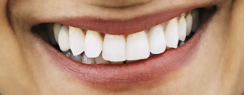 Sonrisa perfecta con implantes dentales en clínica dental de Vega Alta PR