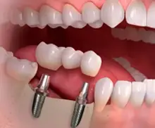 Puente dental soportado por implantes para reemplazar múltiples dientes en Vega Alta PR